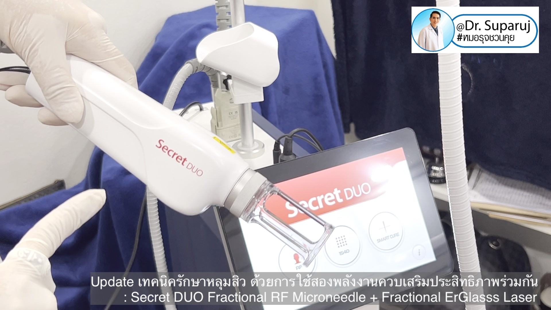 Update เทคนิครักษาหลุมสิว ด้วยการใช้สองพลังงานเสริมประสิทธิภาพร่วมกัน: Secret DUO Fractional RF Microneedle + Fractional ErGlasss Laser