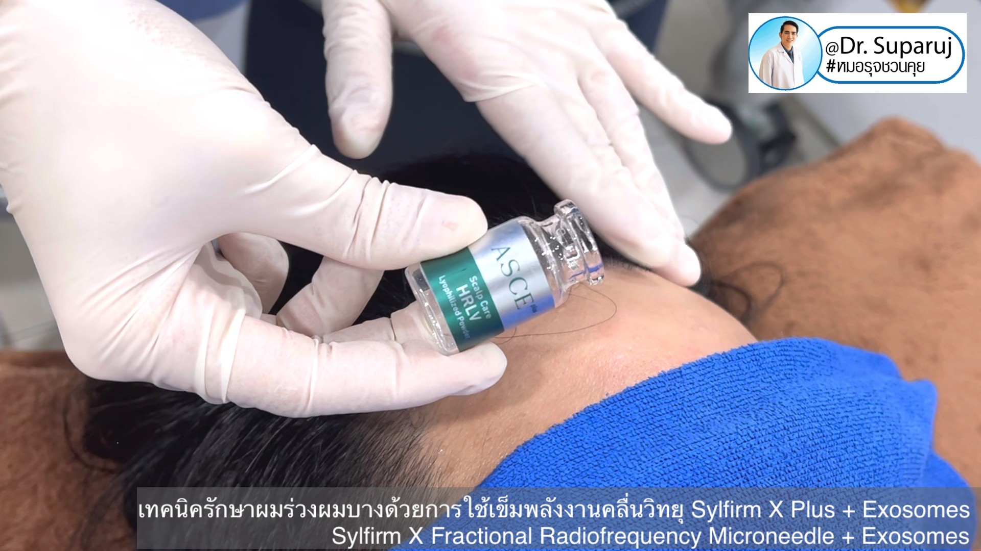 แนะนำ เทคนิครักษาผมร่วงผมบางด้วยการใช้เข็มพลังงานคลื่นวิทยุ Sylfirm X Plus + Exosomes (Sylfirm X Fractional Radiofrequency Microneedle + Exosomes) แนะนำ เทคนิครักษาผมร่วงผมบางด้วยการใช้เข็มพลังงานคลื่นวิทยุ Sylfirm X Plus + Exosomes (Sylfirm X Fractional Radiofrequency Microneedle + Exosomes)