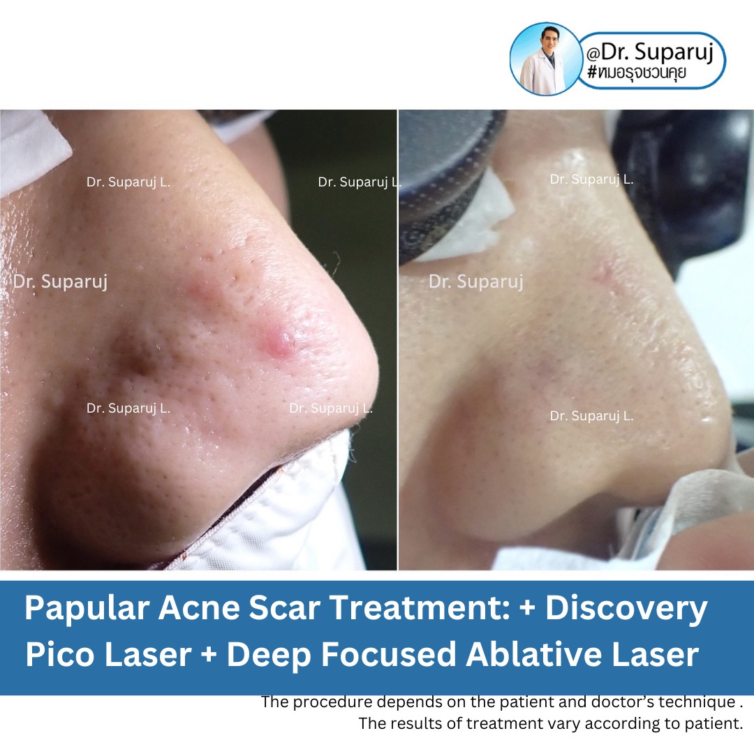 แนะนำเทคนิคดูแลแผลเป็นนูนคีลอยด์: รักษาแผลเป็นนูนด้วยทิกเซลล์ Tixel Fractional ThermoMechanical Ablation Devices + Exosomes แนะนำเทคนิคดูแลแผลเป็นนูนคีลอยด์: รักษาแผลเป็นนูนด้วยทิกเซลล์ Tixel Fractional ThermoMechanical Ablation Devices + Exosomes