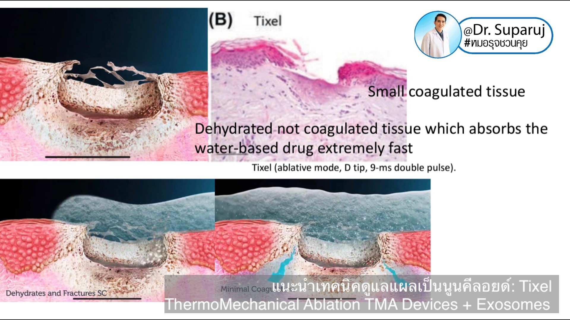 แนะนำเทคนิคดูแลแผลเป็นนูนคีลอยด์: รักษาแผลเป็นนูนด้วยทิกเซลล์ Tixel Fractional ThermoMechanical Ablation Devices + Exosomes แนะนำเทคนิคดูแลแผลเป็นนูนคีลอยด์: รักษาแผลเป็นนูนด้วยทิกเซลล์ Tixel Fractional ThermoMechanical Ablation Devices + Exosomes