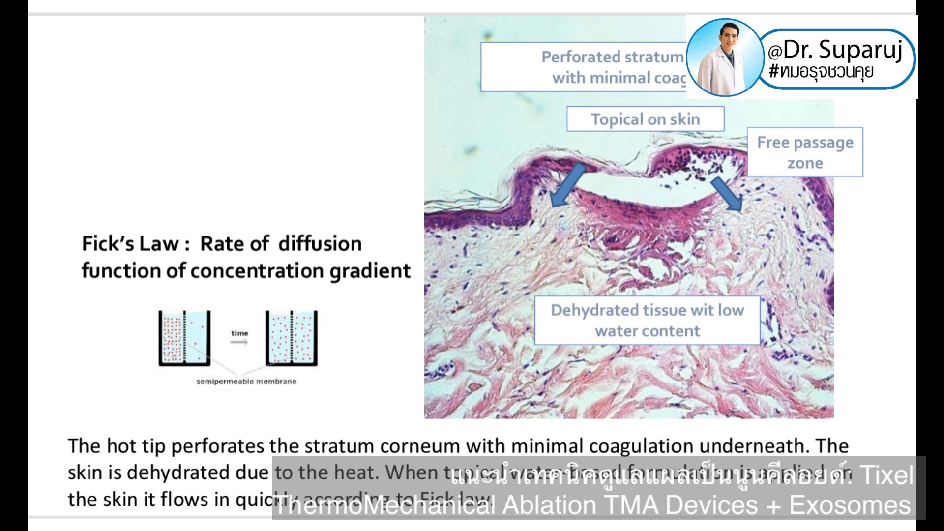 แนะนำเทคนิคดูแลแผลเป็นนูนคีลอยด์: รักษาแผลเป็นนูนด้วยทิกเซลล์ Tixel Fractional ThermoMechanical Ablation Devices + Exosomes แนะนำเทคนิคดูแลแผลเป็นนูนคีลอยด์: รักษาแผลเป็นนูนด้วยทิกเซลล์ Tixel Fractional ThermoMechanical Ablation Devices + Exosomes