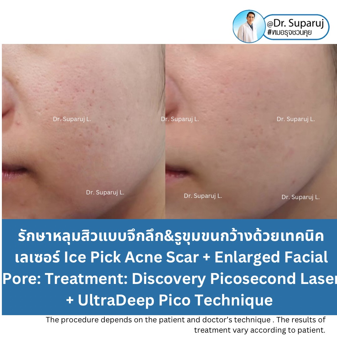 แนะนำเทคนิคดูแลรักษาหลุมสิว: เทคนิครักษาหลุมสิวด้วย 2 เทคนิคเสริมประสิทธิภาพ SYLFIRM X Plus + Discovery Pico Laser Combination Treatment แนะนำเทคนิคดูแลรักษาหลุมสิว: เทคนิครักษาหลุมสิวด้วย 2 เทคนิคเสริมประสิทธิภาพ SYLFIRM X Plus + Discovery Pico Laser Combination Treatment