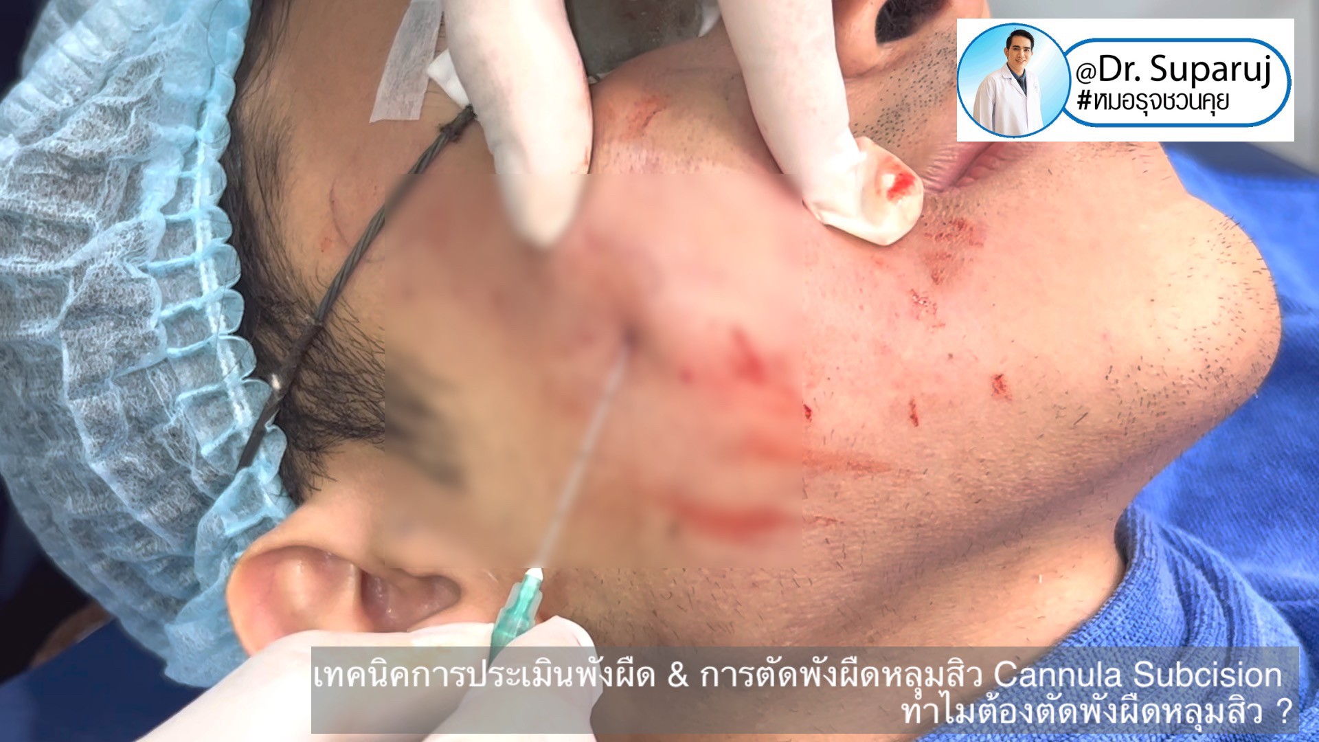 เทคนิคการประเมินพังผืด และการตัดพังผืดหลุมสิว Cannula Subcision ทำไมต้องตัดพังผืดรักษาหลุมสิว ?(Acne Scar Fibrosis Evaluation & Cannula Subcision Treatment) เทคนิคการประเมินพังผืด และการตัดพังผืดหลุมสิว Cannula Subcision ทำไมต้องตัดพังผืดรักษาหลุมสิว ?(Acne Scar Fibrosis Evaluation & Cannula Subcision Treatment)