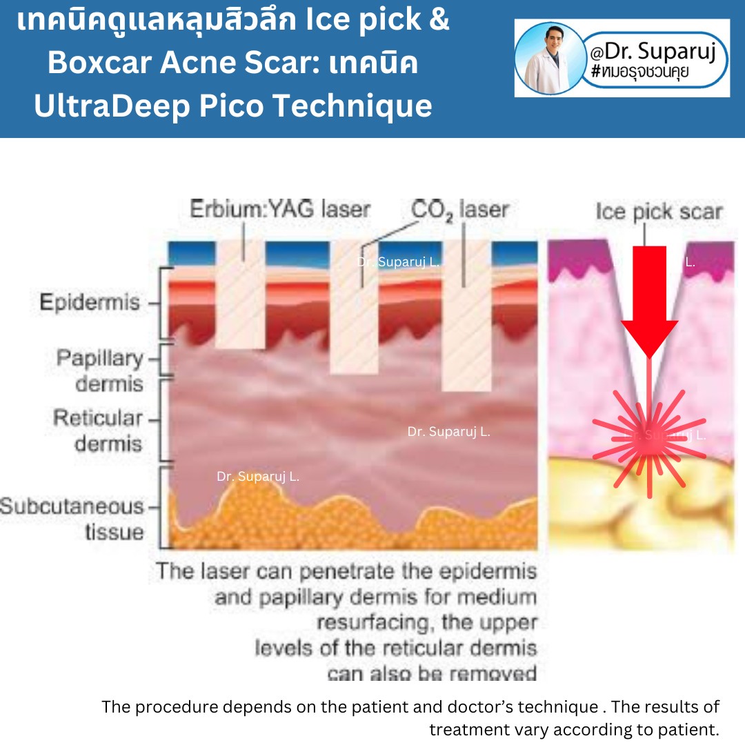 แนะนำเทคนิคดูแลหลุมสิวลึก Ice pick & Boxcar Acne Scar: เทคนิค UltraDeep Pico Technique