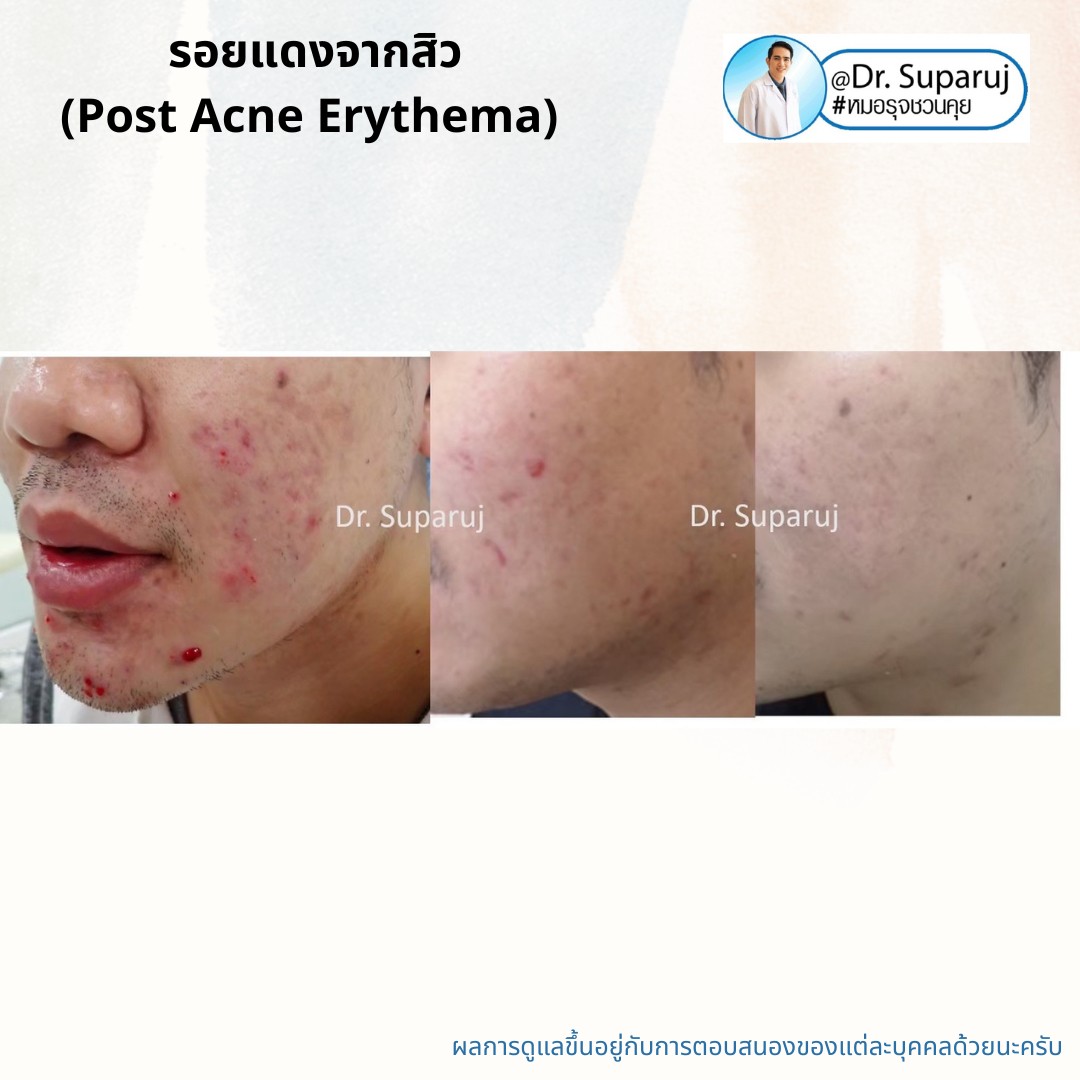 แชร์ประสบการณ์ Discovery Pico Laser พลีชีพความจริง แชร์ประสบการณ์ Discovery Pico Laser พลีชีพความจริง