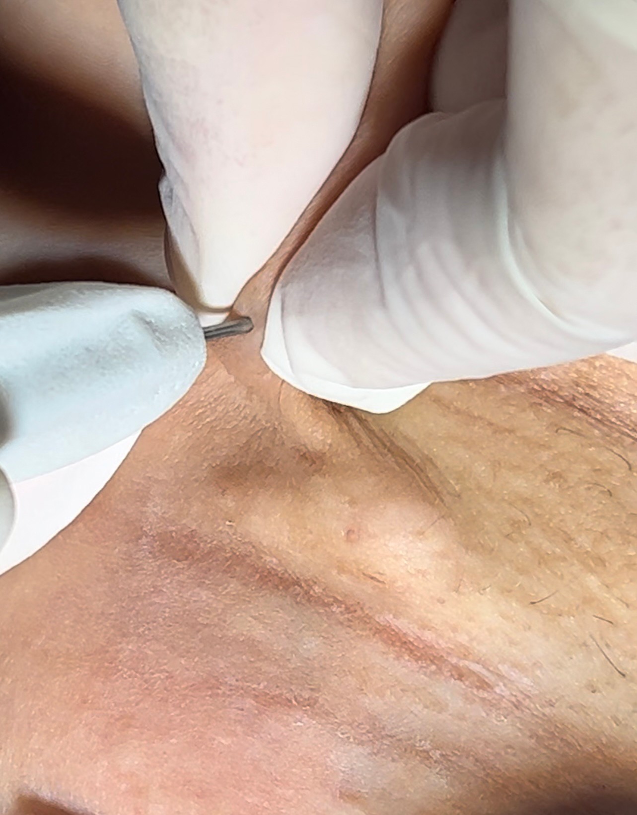 แนะนำเทคนิคดูแล ก้อนซีสต์จากท่อต่อมไขมัน Steatocystoma Multiplex (SM) ด้วย เข็มพลังงานคลื่นวิทยุ Insulated Radiofrequency RF Microneedle for Steatocystoma Multiplex Treatment แนะนำเทคนิคดูแล ก้อนซีสต์จากท่อต่อมไขมัน Steatocystoma Multiplex (SM) ด้วย เข็มพลังงานคลื่นวิทยุ Insulated Radiofrequency RF Microneedle for Steatocystoma Multiplex Treatment