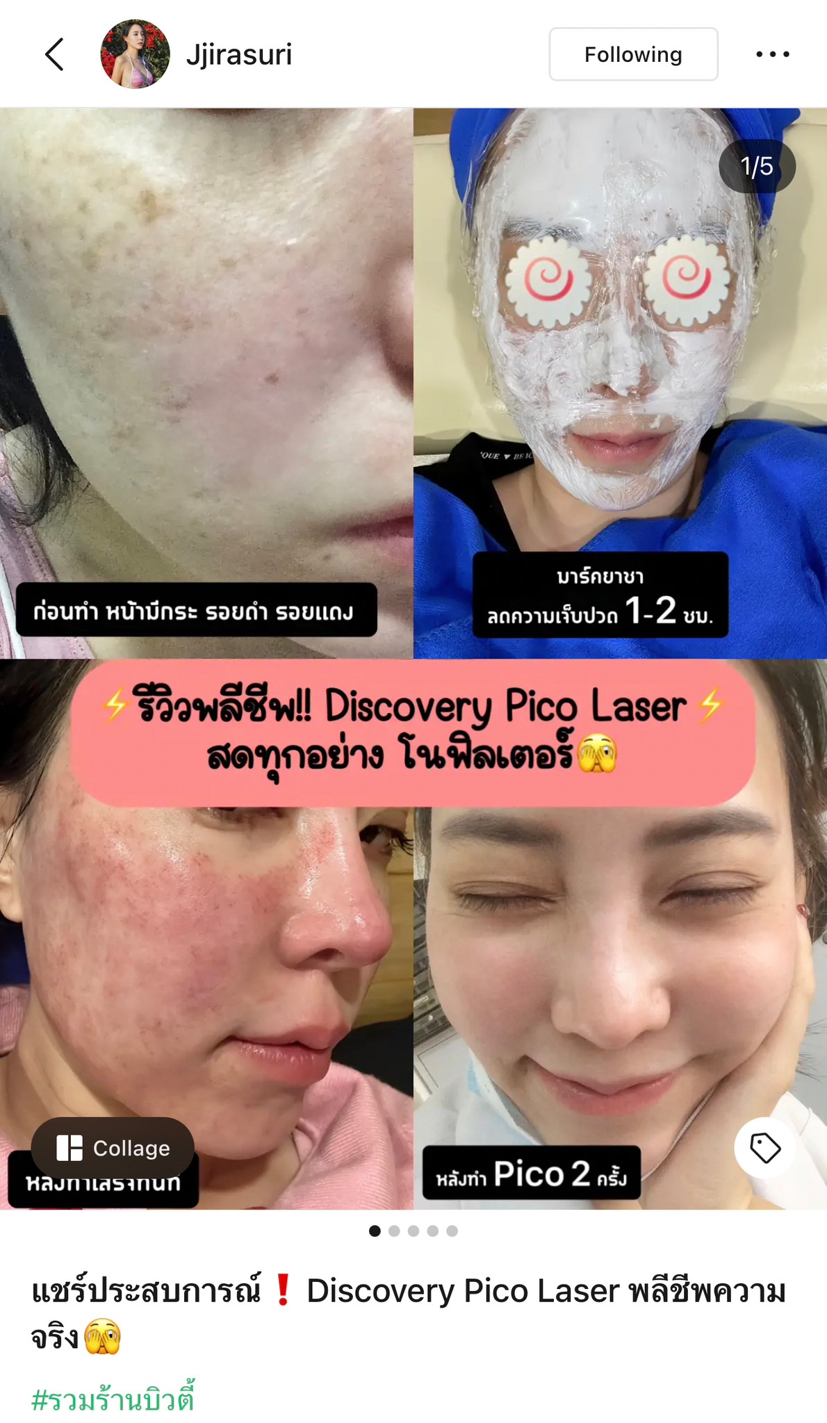 แชร์ประสบการณ์ Discovery Pico Laser พลีชีพความจริง แชร์ประสบการณ์ Discovery Pico Laser พลีชีพความจริง