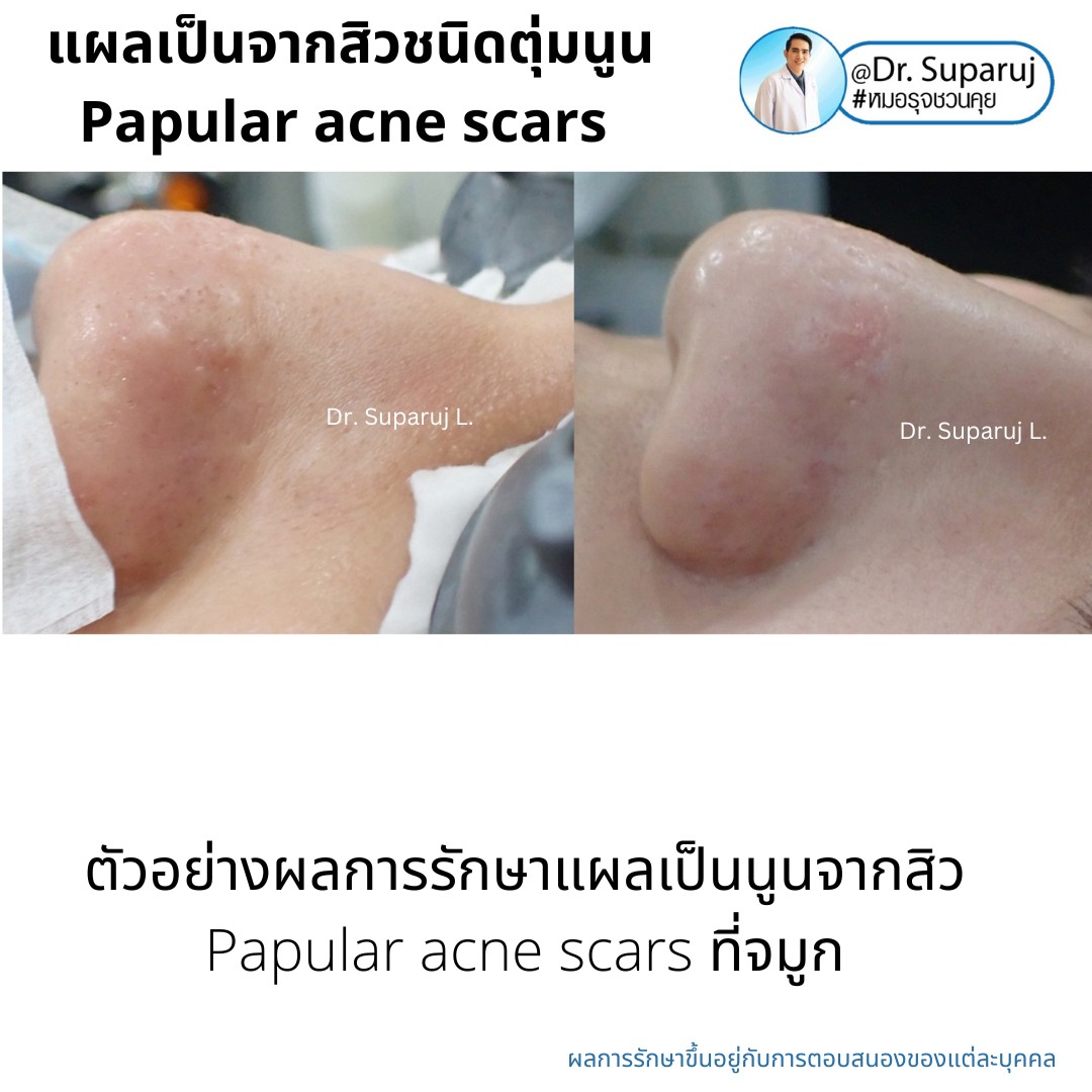 เทคนิคดูแลแผลเป็นตุ่มนูนจากสิว Papular acne scar ที่จมูก + คาง ด้วย Fractional Discovery Picosecond Laser + Deep Focused Ablative Laser เทคนิคดูแลแผลเป็นตุ่มนูนจากสิว Papular acne scar ที่จมูก + คาง ด้วย Fractional Discovery Picosecond Laser + Deep Focused Ablative Laser