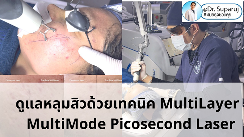 เทคนิครักษาหลุมสิวด้วยเลเซอร์ MultiLayer MultiMode Picosecond Laser