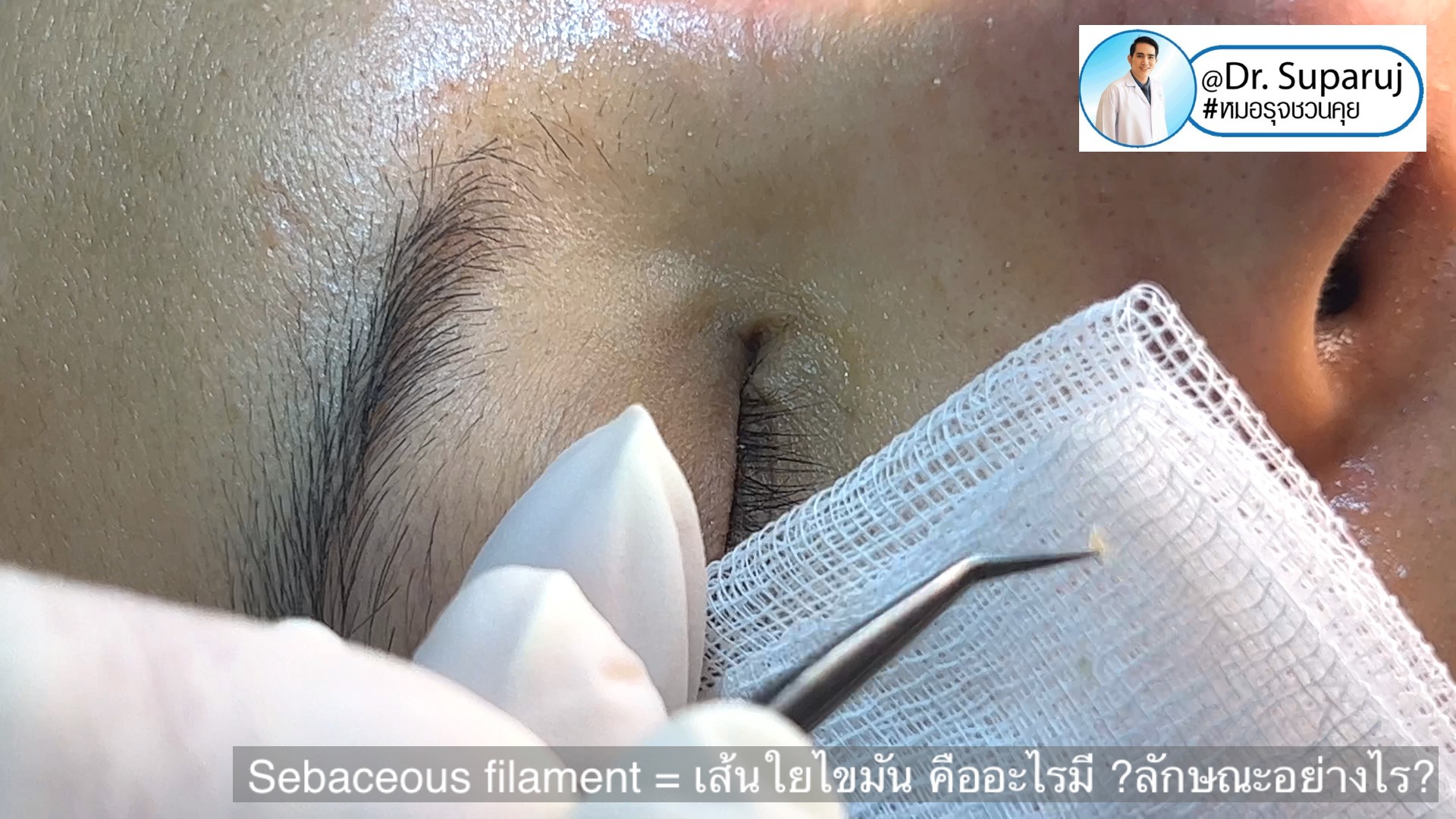Sebaceous filament = เส้นใยไขมัน คืออะไรมี ?ลักษณะอย่างไร ? ดูแลได้อย่างไร? Sebaceous filament = เส้นใยไขมัน คืออะไรมี ?ลักษณะอย่างไร ? ดูแลได้อย่างไร?