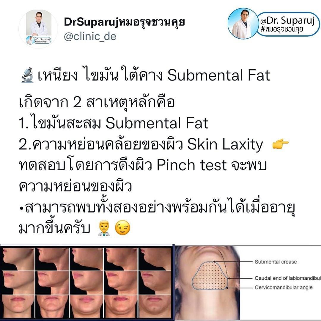 สาเหตุ & เทคนิคลดเหนียง ไขมันใต้คาง คาง 2 ชั้น Double Chin & Submental Fullness Treatment  สาเหตุ & เทคนิคลดเหนียง ไขมันใต้คาง คาง 2 ชั้น Double Chin & Submental Fullness Treatment