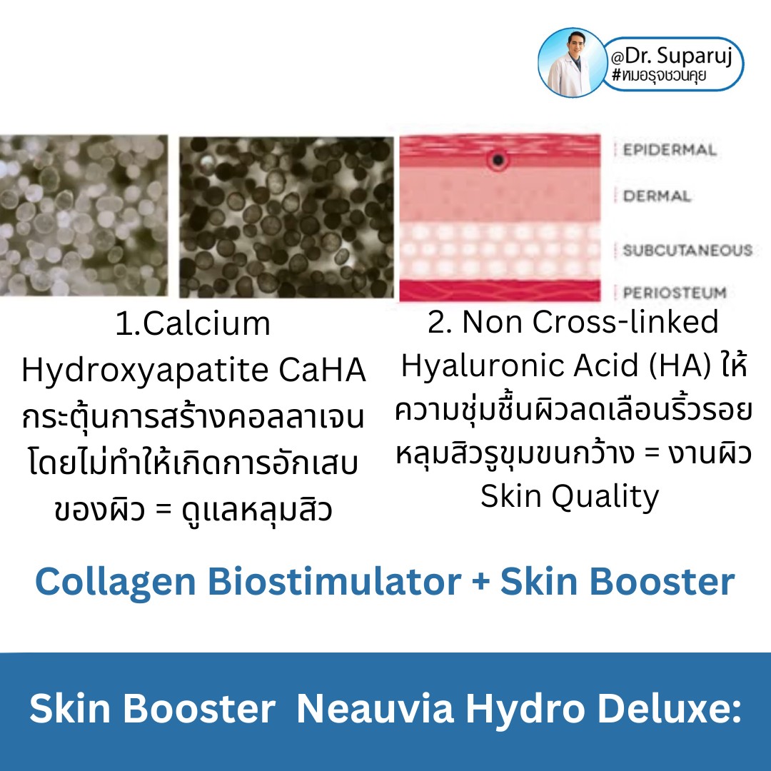 Update Skin Booster ตัวใหม่ Neauvia Hydro Deluxe: Calcium Hydroxyapatite CaHA สร้างคอลลาเจนหลุมสิว Collagen Biostimulator + Non Cross-linked Hyaluronic Acid (HA) ให้ความชุ่มชื้นผิว Skin Booster ครับ Update Skin Booster ตัวใหม่ Neauvia Hydro Deluxe: Calcium Hydroxyapatite CaHA สร้างคอลลาเจนหลุมสิว Collagen Biostimulator + Non Cross-linked Hyaluronic Acid (HA) ให้ความชุ่มชื้นผิว Skin Booster ครับ