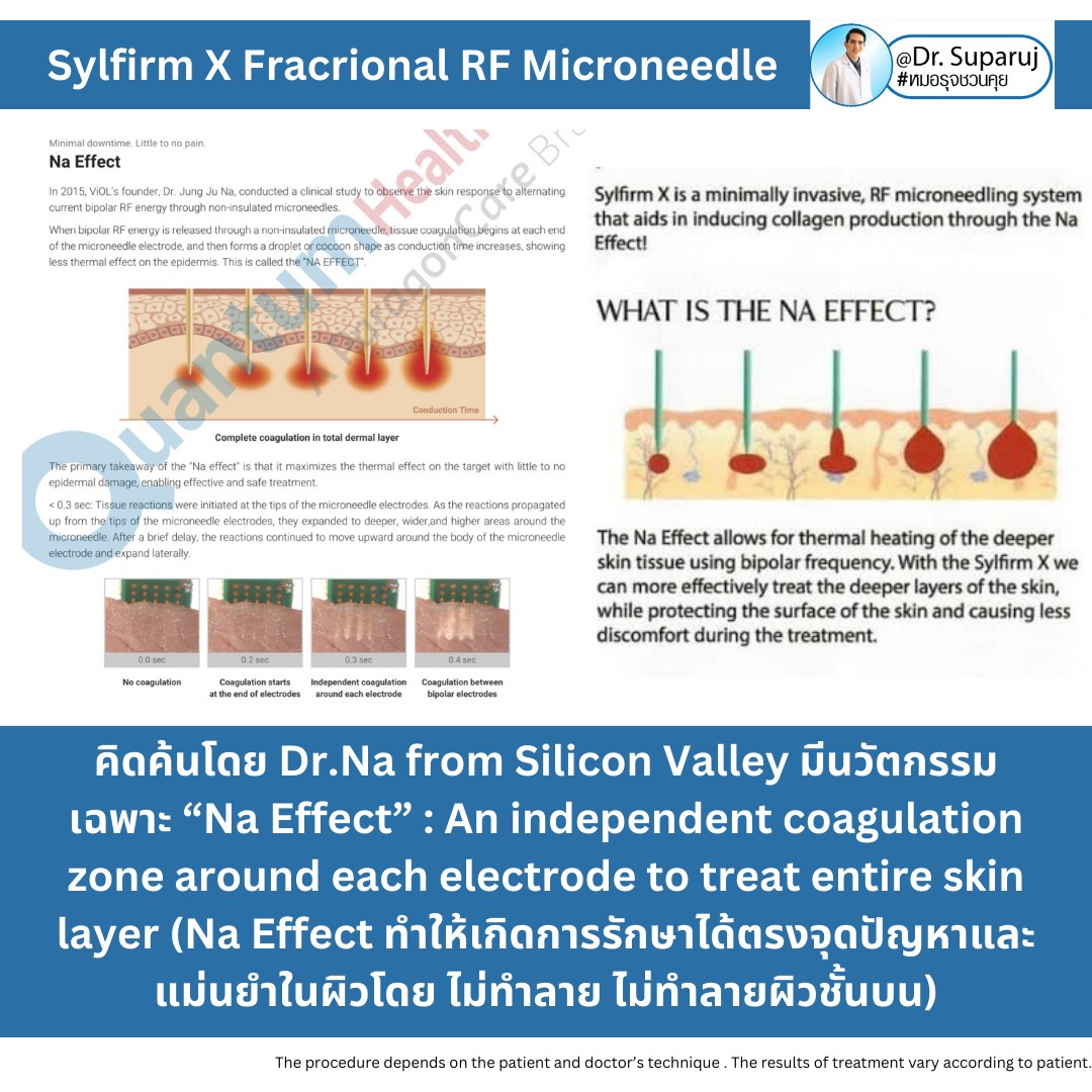 แนะนำเทคนิคดูแลแผลเป็นหลุมสิวด้วย SYLFIRM X Plus + Exosomes (SYLFIRM X Plus & Exosomes for Acne Scar Treatment)