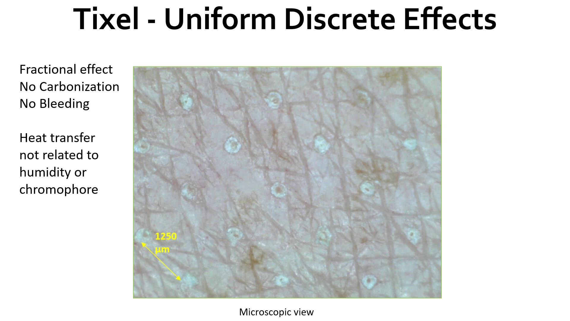 Update เทคนิครักษาหลุมสิว: Tixel ทิ๊กเซลล์ รักษาหลุมสิว ริ้วรอย แผลเป็น เพิ่มการดูดซึมยาด้วยเทคนิค TMA = Thermo-mechanical Abaltion Update เทคนิครักษาหลุมสิว: Tixel ทิ๊กเซลล์ รักษาหลุมสิว ริ้วรอย แผลเป็น เพิ่มการดูดซึมยาด้วยเทคนิค TMA = Thermo-mechanical Abaltion