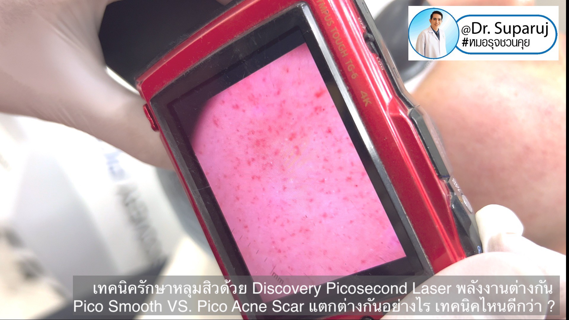 Q:Picosecond Laser หลุมสิวต้องยิงให้เลือดสาดไหม? Q:Picosecond Laser หลุมสิวต้องยิงให้เลือดสาดไหม?