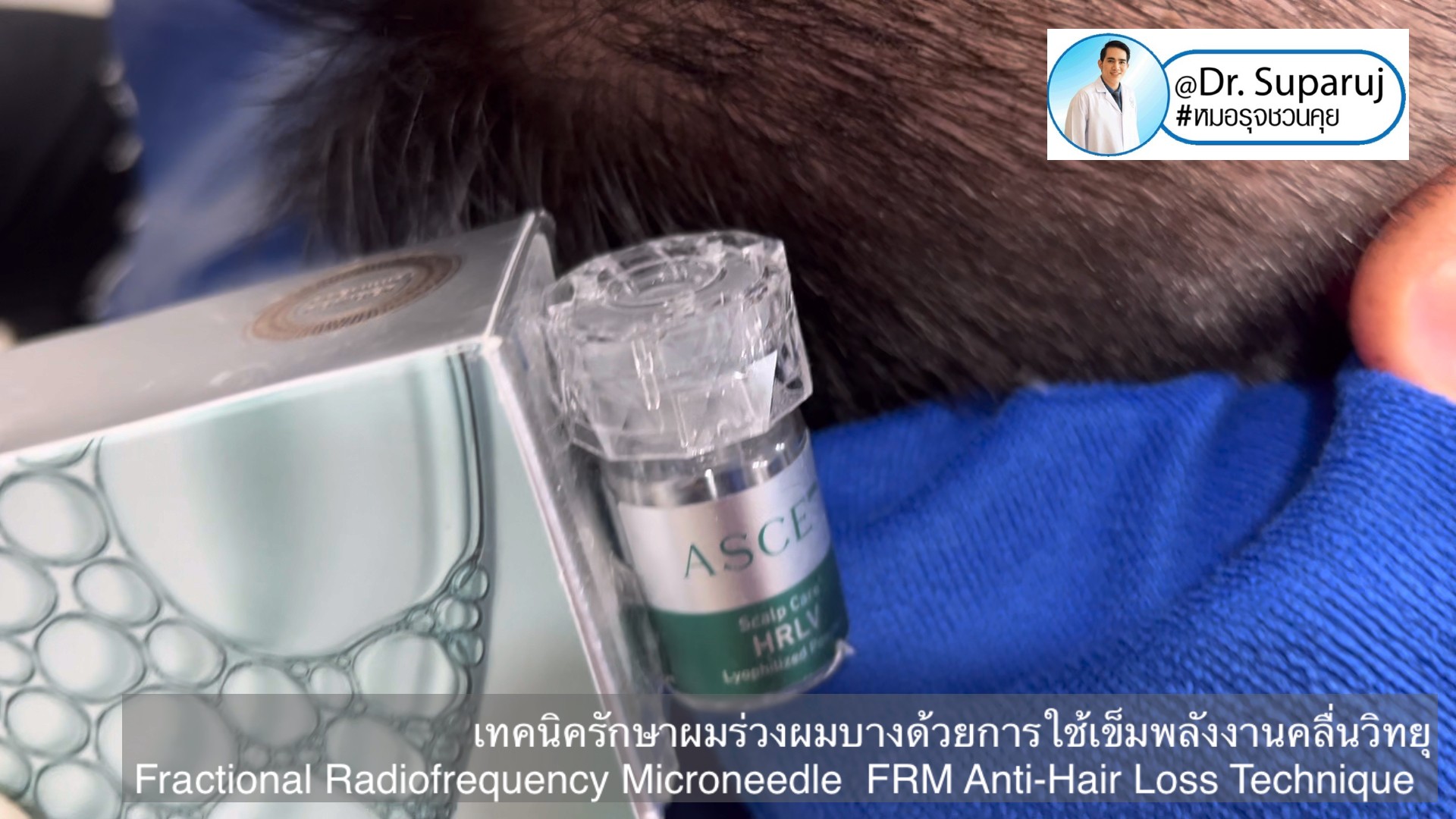 แนะนำเทคนิครักษาผมร่วงผมบาง: เทคนิครักษาผมร่วงผมบางด้วยการใช้เข็มพลังงานคลื่นวิทยุ Fractional Radiofrequency Microneedle FRM Anti-Hair Loss Technique แนะนำเทคนิครักษาผมร่วงผมบาง: เทคนิครักษาผมร่วงผมบางด้วยการใช้เข็มพลังงานคลื่นวิทยุ Fractional Radiofrequency Microneedle FRM Anti-Hair Loss Technique