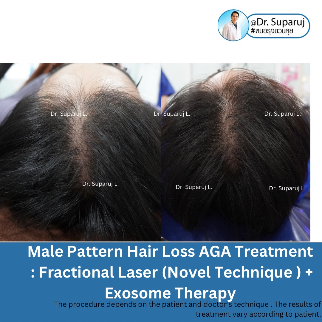 แนะนำเทคนิครักษาผมร่วงผมบาง: เทคนิครักษาผมร่วงผมบางด้วยการใช้เข็มพลังงานคลื่นวิทยุ Fractional Radiofrequency Microneedle FRM Anti-Hair Loss Technique แนะนำเทคนิครักษาผมร่วงผมบาง: เทคนิครักษาผมร่วงผมบางด้วยการใช้เข็มพลังงานคลื่นวิทยุ Fractional Radiofrequency Microneedle FRM Anti-Hair Loss Technique