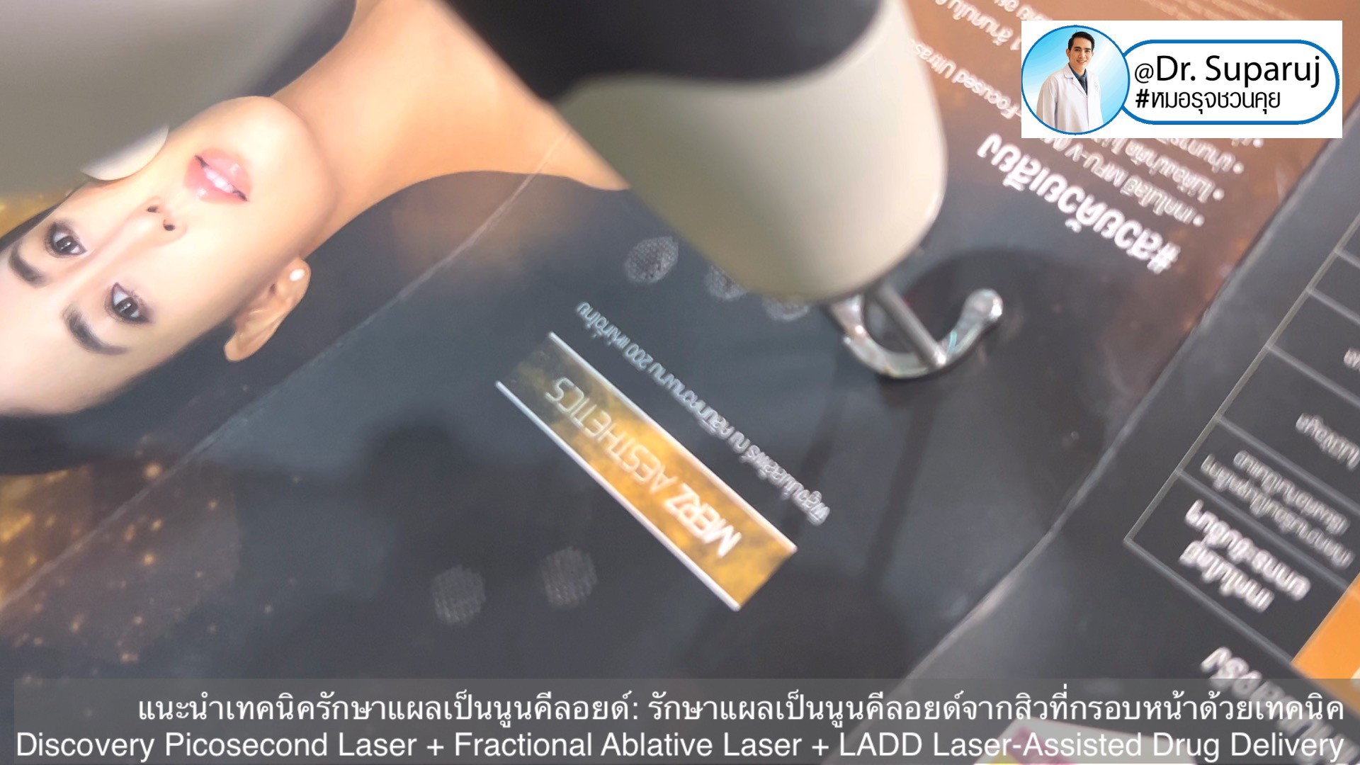 แนะนำเทคนิคดูแลแผลเป็นนูนคีลอยด์: รักษาแผลเป็นนูนคีลอยด์จากสิวที่กรอบหน้าด้วยเทคนิค Discovery Picosecond Laser + Fractional Ablative Laser + LADD Laser-Assisted Drug Delivery แนะนำเทคนิคดูแลแผลเป็นนูนคีลอยด์: รักษาแผลเป็นนูนคีลอยด์จากสิวที่กรอบหน้าด้วยเทคนิค Discovery Picosecond Laser + Fractional Ablative Laser + LADD Laser-Assisted Drug Delivery