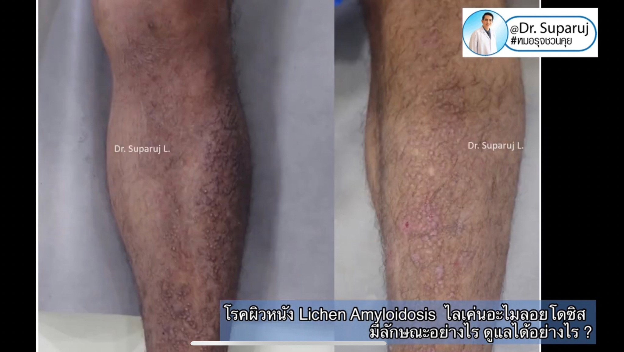 แนะนำการดูแลปัญหาโรคผิวหนัง: โรค Lichen amyloidosis ไลเค่น อะไมลอยโดซิส มีลักษณะอย่างไร ดูแลได้อย่างไร ? แนะนำการดูแลปัญหาโรคผิวหนัง: โรค Lichen amyloidosis ไลเค่น อะไมลอยโดซิส มีลักษณะอย่างไร ดูแลได้อย่างไร ?