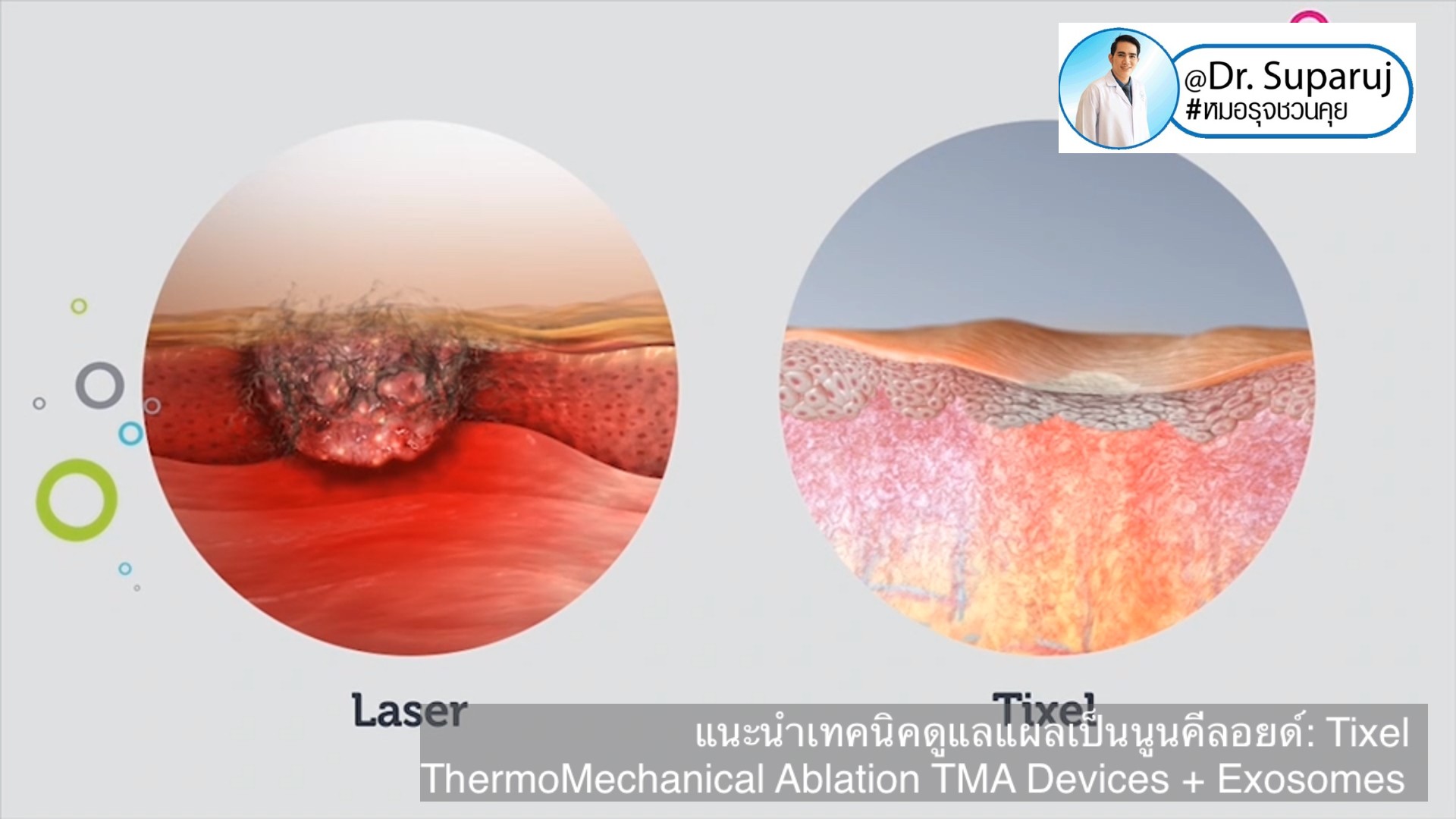 แนะนำเทคนิคดูแลแผลเป็นนูนคีลอยด์: รักษาแผลเป็นนูนด้วยทิกเซลล์ Tixel Fractional ThermoMechanical Ablation Devices + Exosomes แนะนำเทคนิคดูแลแผลเป็นนูนคีลอยด์: รักษาแผลเป็นนูนด้วยทิกเซลล์ Tixel Fractional ThermoMechanical Ablation Devices + Exosomes