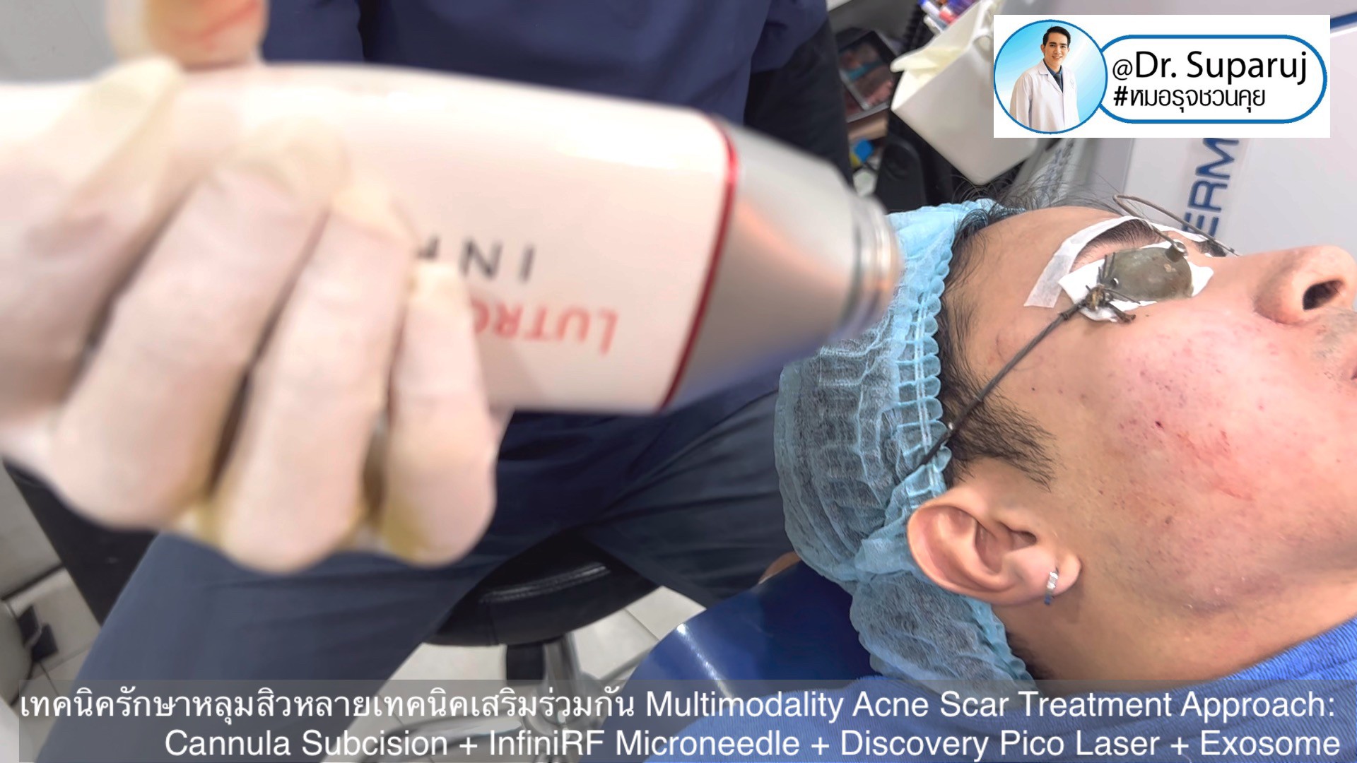 เทคนิครักษาหลุมสิวด้วยหลายเทคนิคเสริมร่วมกัน Multimodality Acne Scar Treatment Approach: Cannula Subcision + InfiniRF Microneedle + Discovery Pico Laser + Exosome