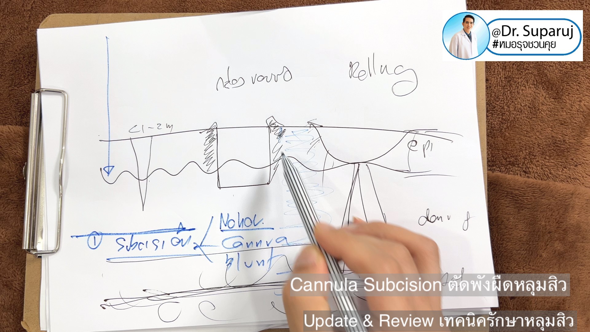 Update & Review เทคนิครักษาหลุมสิว (Acne Scar Treatment: Update & Review) Update & Review เทคนิครักษาหลุมสิว (Acne Scar Treatment: Update & Review)