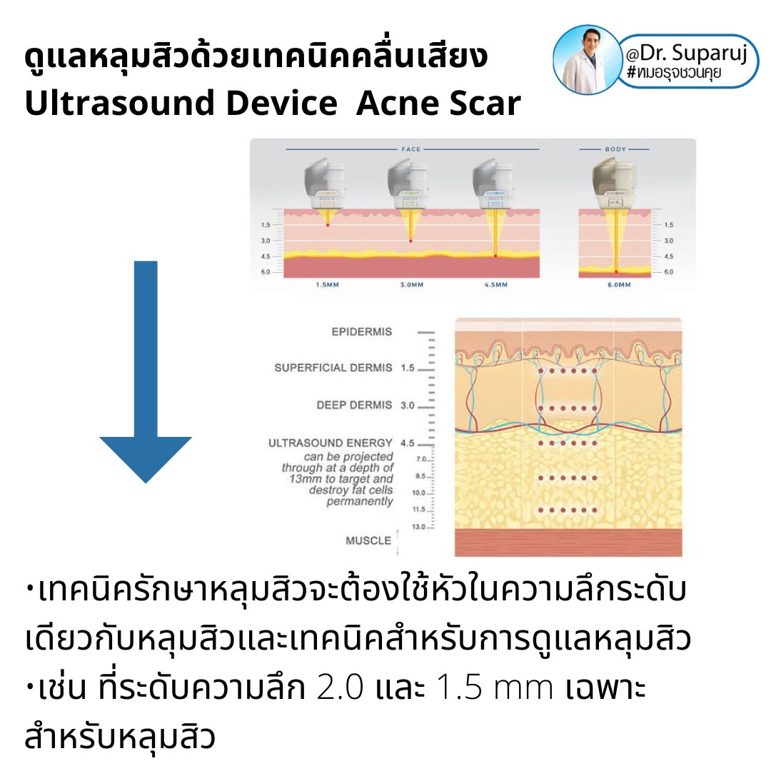 เทคโนโลยียกกระชับผิว MMFU : Micro &Macro Focused Ultrasound ของ Ultraformer III ทำงานอย่างไร ทำไมถึงดีกว่า HIFU ? เทคโนโลยียกกระชับผิว MMFU : Micro &Macro Focused Ultrasound ของ Ultraformer III ทำงานอย่างไร ทำไมถึงดีกว่า HIFU ?