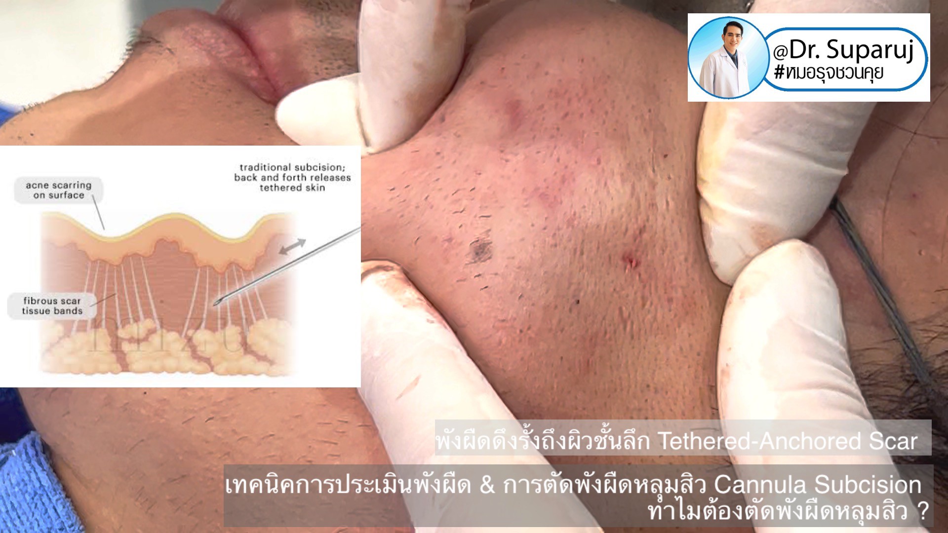 เทคนิคการประเมินพังผืด และการตัดพังผืดหลุมสิว Cannula Subcision ทำไมต้องตัดพังผืดรักษาหลุมสิว ?(Acne Scar Fibrosis Evaluation & Cannula Subcision Treatment) 