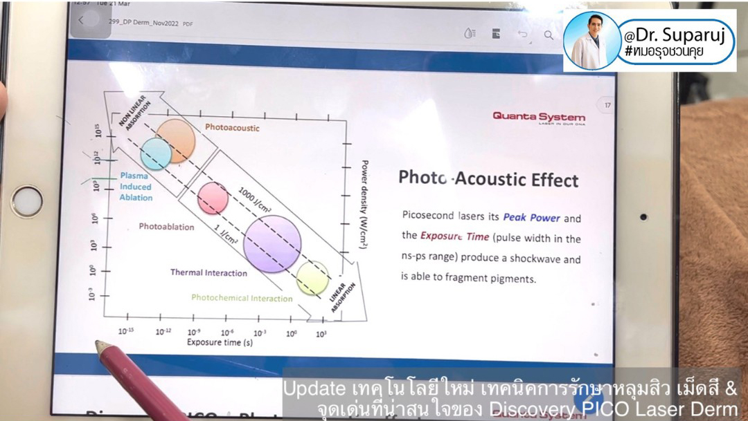 Update Discovery Picosecond Laser จุดเด่น & หลักการทำงาน ใช้ดูแลหลุมสิว แผลเป็น รอยแตกลาย ฝ้า กระจุดด่างดำ ได้อย่างไร ?  Update Discovery Picosecond Laser จุดเด่น & หลักการทำงาน ใช้ดูแลหลุมสิว แผลเป็น รอยแตกลาย ฝ้า กระจุดด่างดำ ได้อย่างไร ?