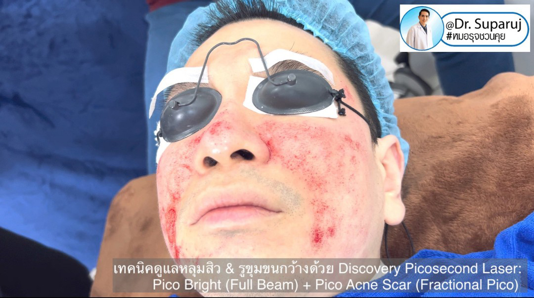 Update Discovery Picosecond Laser จุดเด่น & หลักการทำงาน ใช้ดูแลหลุมสิว แผลเป็น รอยแตกลาย ฝ้า กระจุดด่างดำ ได้อย่างไร ? 