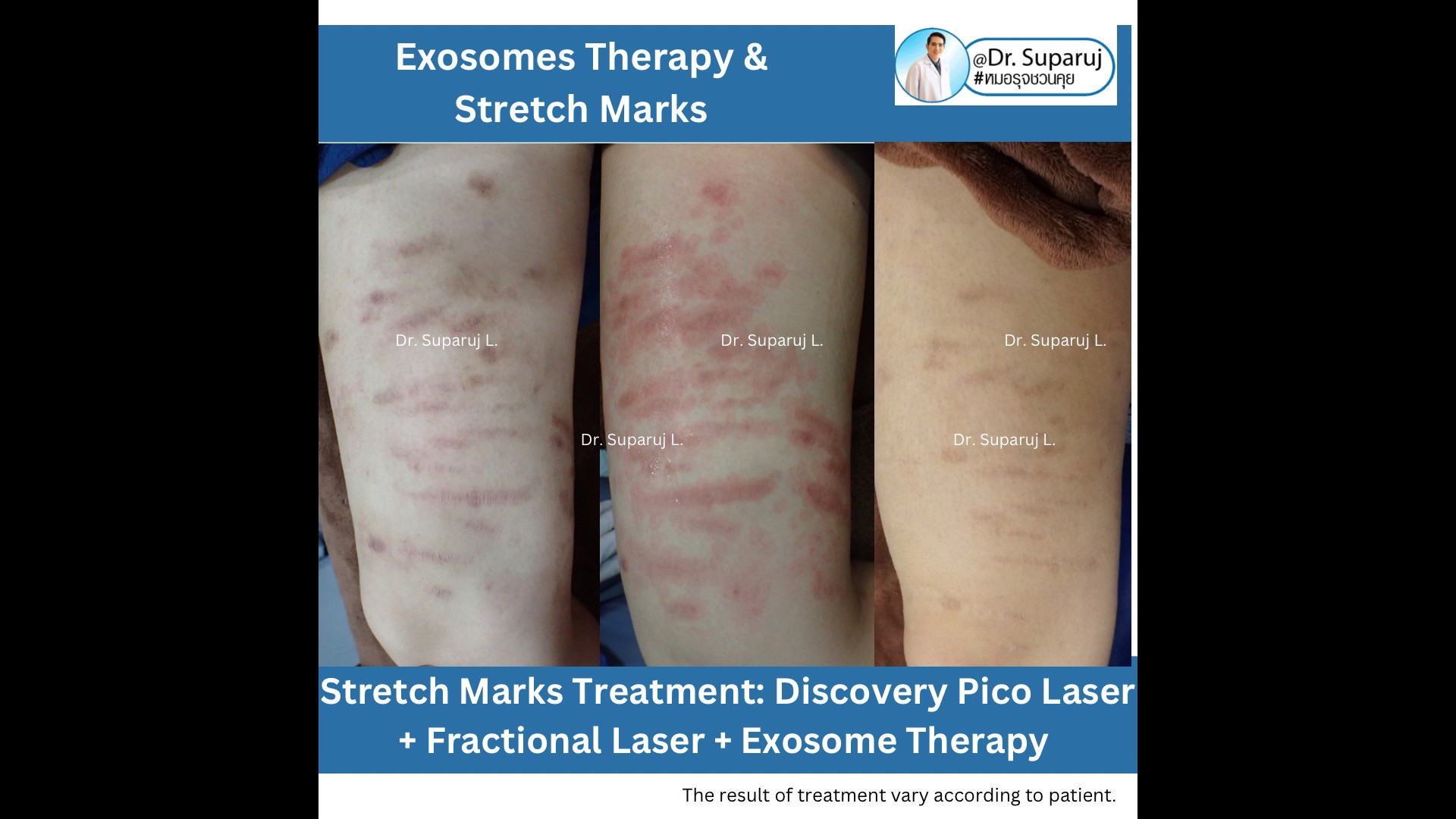แนะนำเทคนิคดูแลรอยแตกลาย: รักษาผิวแตกลายด้วยเทคนิคเลเซอร์ Discovery Pico Laser + Fractional Ablative Laser + Exosomes แนะนำเทคนิคดูแลรอยแตกลาย: รักษาผิวแตกลายด้วยเทคนิคเลเซอร์ Discovery Pico Laser + Fractional Ablative Laser + Exosomes