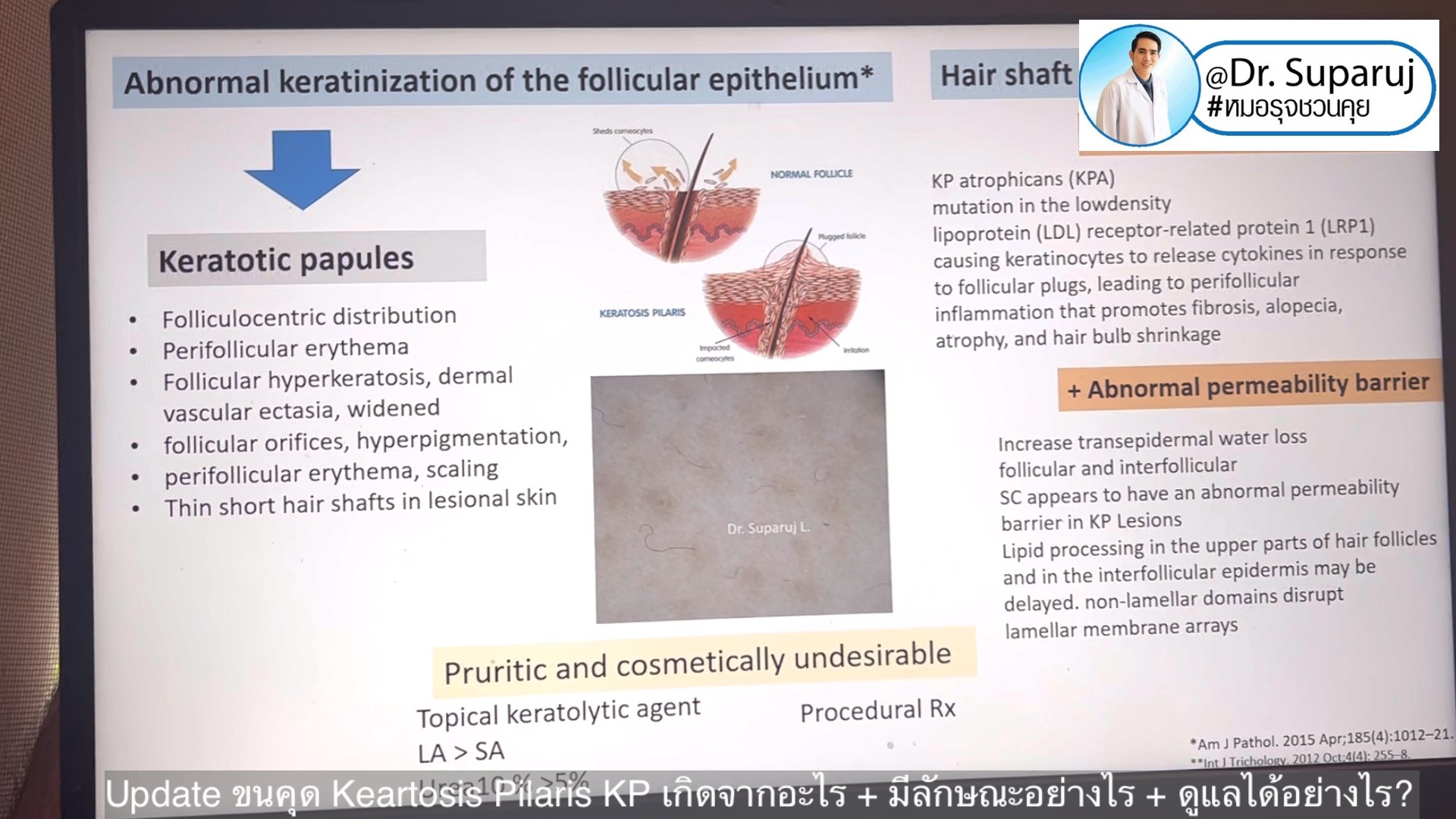 Update ขนคุด Keartosis Pilaris KP เกิดจากอะไร + มีลักษณะอย่างไร + ดูแลได้อย่างไร? Update ขนคุด Keartosis Pilaris KP เกิดจากอะไร + มีลักษณะอย่างไร + ดูแลได้อย่างไร?