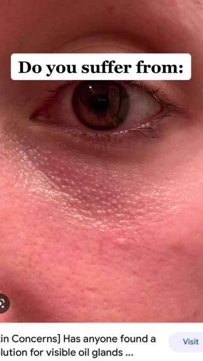 มีตุ่มเล็กๆสีขาวเหลืองหลายๆตุ่มที่เปลือกตาล่างคืออะไร : เป็นต่อมไขมันที่เด่นชัดครับ Prominent sebaceous gland ครับ มีตุ่มเล็กๆสีขาวเหลืองหลายๆตุ่มที่เปลือกตาล่างคืออะไร : เป็นต่อมไขมันที่เด่นชัดครับ Prominent sebaceous gland ครับ