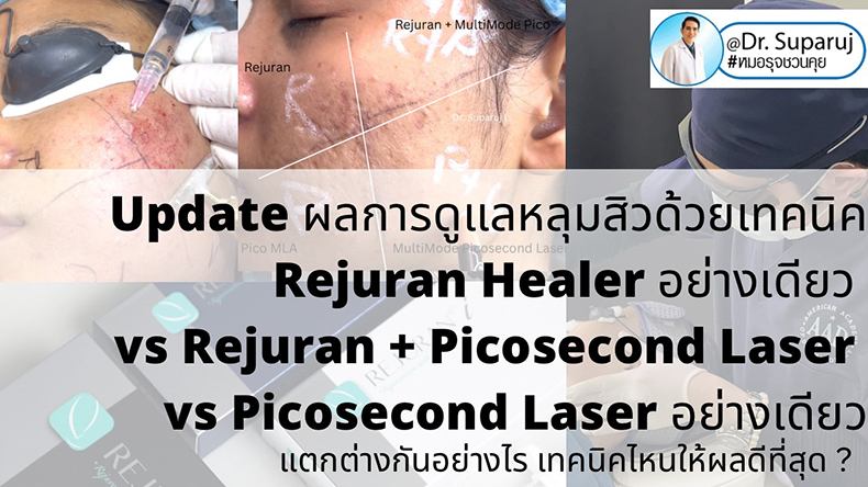 Update ผลการรักษาหลุมสิวด้วยเทคนิค Rejuran Healer อย่างเดียว vs Rejuran + Picosecond Laser vs Picosecond Laser อย่างเดียว แตกต่างกันอย่างไร เทคนิคไหนให้ผลดีที่สุด ? 