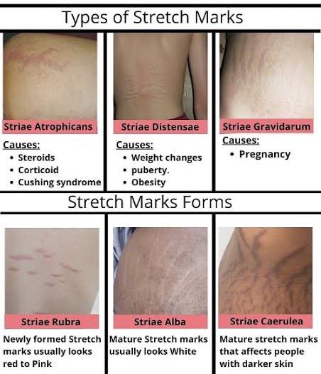 แนะนำเทคนิคดูแลรอยแตกลาย: รักษาผิวแตกลายด้วยเทคนิคเลเซอร์ Discovery Pico Laser + Fractional Ablative Laser + Exosomes แนะนำเทคนิคดูแลรอยแตกลาย: รักษาผิวแตกลายด้วยเทคนิคเลเซอร์ Discovery Pico Laser + Fractional Ablative Laser + Exosomes