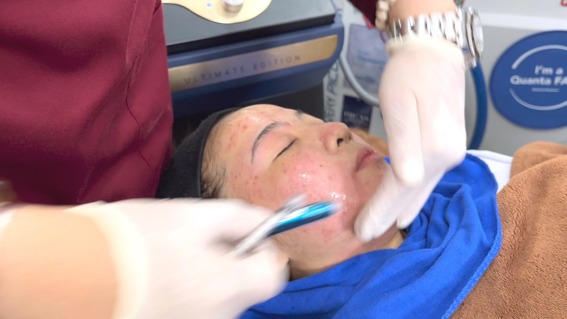 แนะนำเทคนิคดูแลแผลเป็นหลุมสิวด้วย SYLFIRM X Plus + Exosomes (SYLFIRM X Plus & Exosomes for Acne Scar Treatment) แนะนำเทคนิคดูแลแผลเป็นหลุมสิวด้วย SYLFIRM X Plus + Exosomes (SYLFIRM X Plus & Exosomes for Acne Scar Treatment)