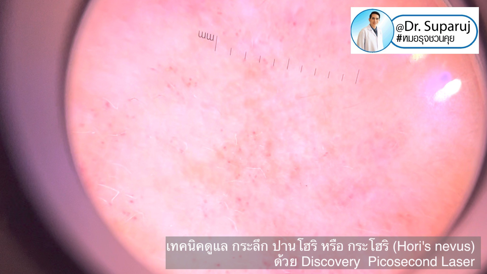 เทคนิครักษากระโฮริ กระลึก ปานโฮริ (Hori's nevus) ด้วยเลเซอร์ Discovery Picosecond Laser เทคนิครักษากระโฮริ กระลึก ปานโฮริ (Hori's nevus) ด้วยเลเซอร์ Discovery Picosecond Laser