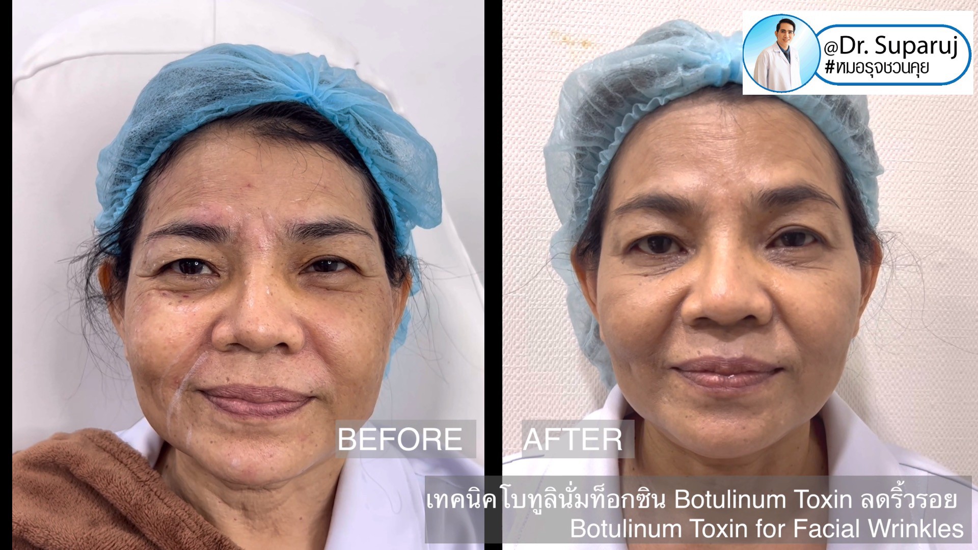 เทคนิคโบทูลินั่มท็อกซิน Botulinum Toxin ลดริ้วรอย Botulinum Toxin for Facial Wrinkles เทคนิคโบทูลินั่มท็อกซิน Botulinum Toxin ลดริ้วรอย Botulinum Toxin for Facial Wrinkles