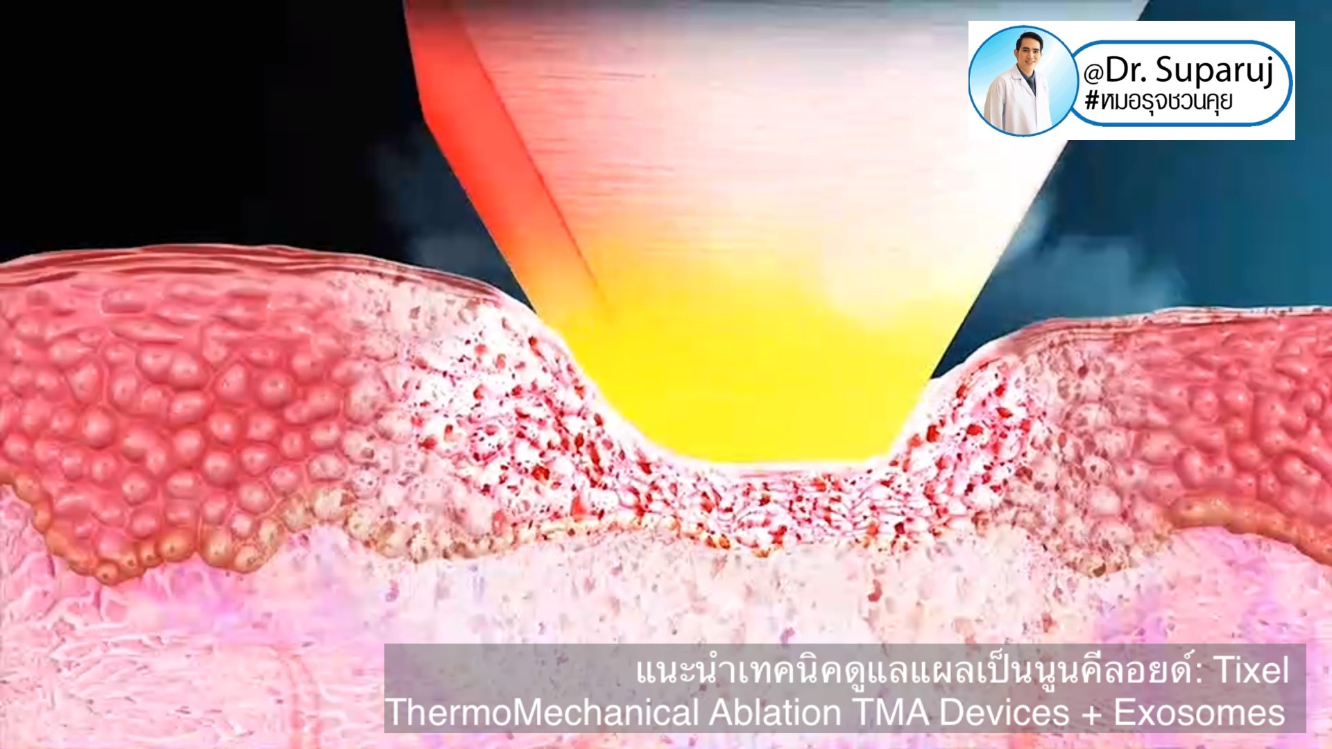 แนะนำเทคนิคดูแลแผลเป็นนูนคีลอยด์: รักษาแผลเป็นนูนด้วยทิกเซลล์ Tixel Fractional ThermoMechanical Ablation Devices + Exosomes แนะนำเทคนิคดูแลแผลเป็นนูนคีลอยด์: รักษาแผลเป็นนูนด้วยทิกเซลล์ Tixel Fractional ThermoMechanical Ablation Devices + Exosomes