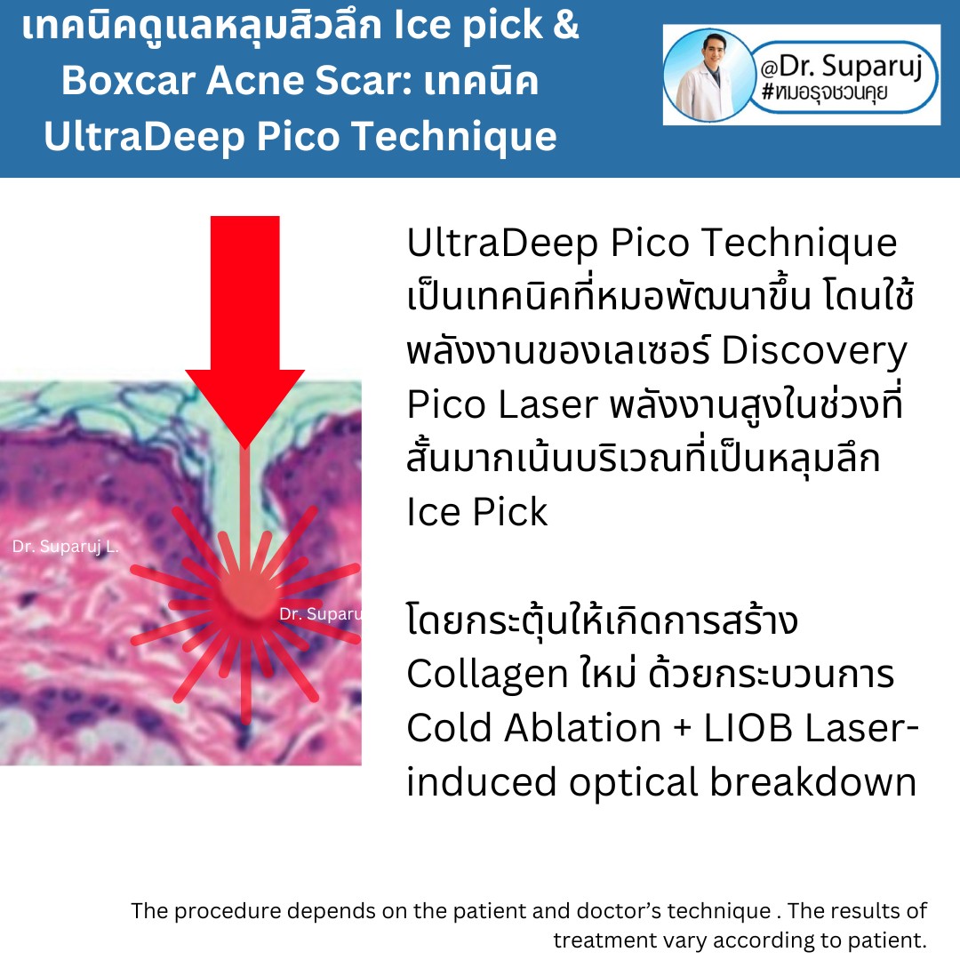 แนะนำเทคนิคดูแลหลุมสิวลึก Ice pick & Boxcar Acne Scar: เทคนิค UltraDeep Pico Technique