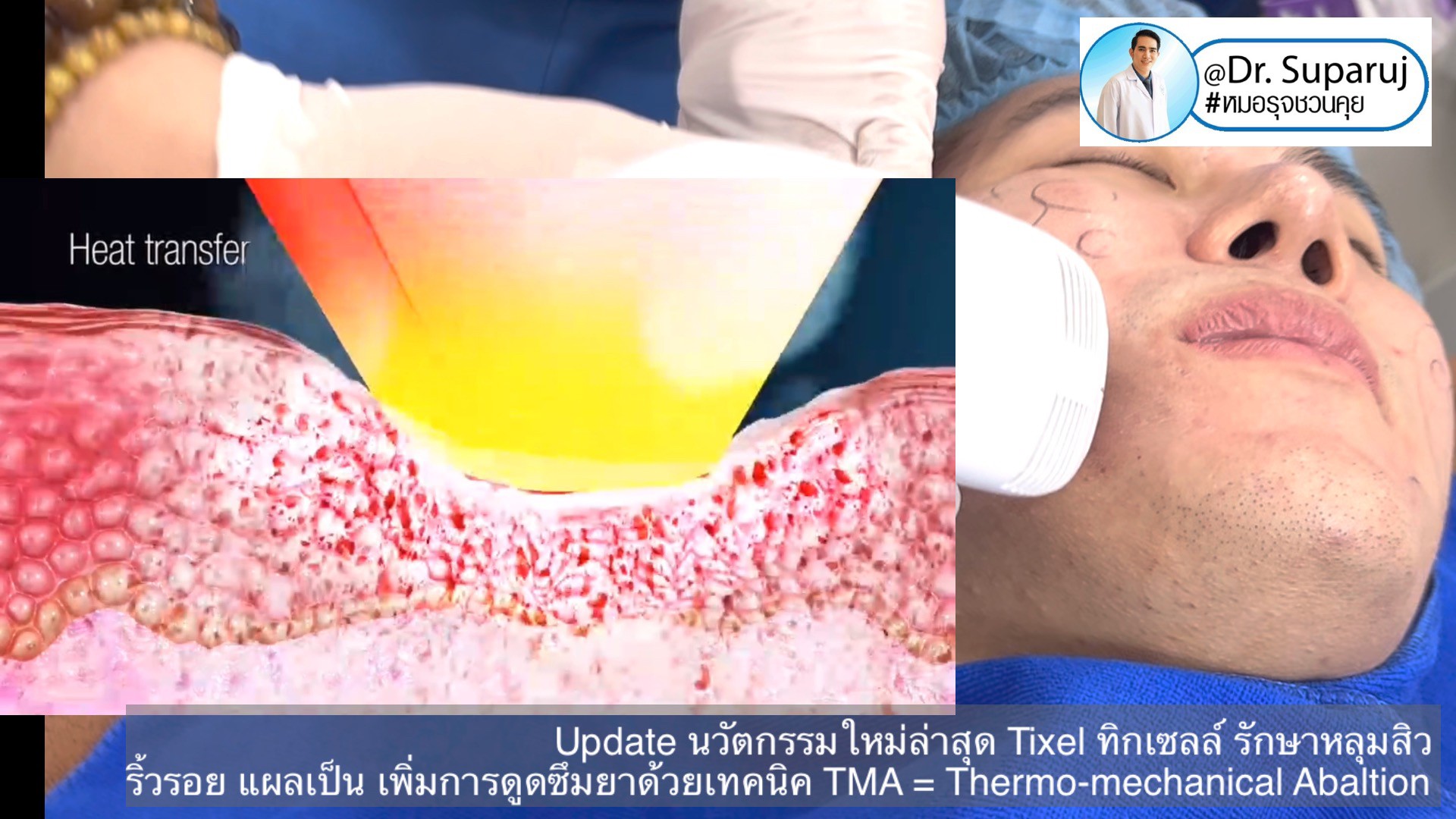 Update นวัตกรรมใหม่ล่าสุด Tixel ทิ๊กเซลล์ รักษาหลุมสิว ริ้วรอย แผลเป็น + Periorbital Tixel Treatment ดูแลริ้วรอยเปลือกตาและรอบดวงตาด้วยเทคนิค TMA = Thermo-mechanical Abaltion