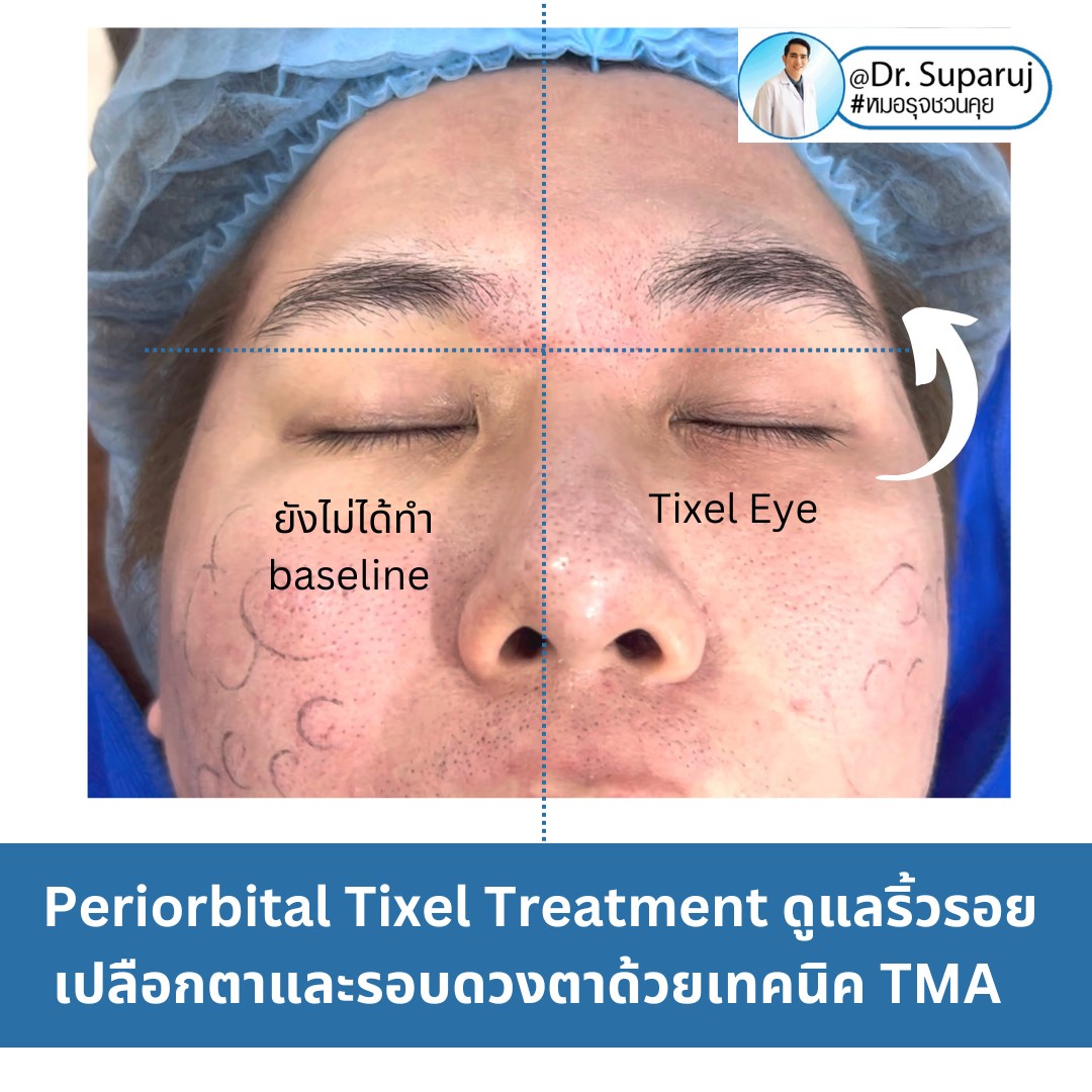 แนะนำเทคนิครักษาหลุมสิวและสิวอักเสบ: ประเมินชนิดความรุนแรงหลุมสิว + เทคโนโลยี Tixel ทิกเซล+ Exosomes