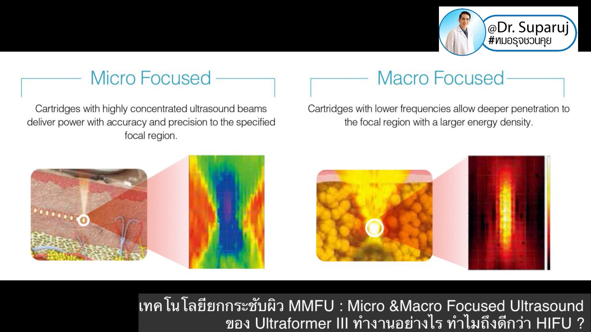 เทคโนโลยียกกระชับผิว MMFU : Micro &Macro Focused Ultrasound ของ Ultraformer III ทำงานอย่างไร ทำไมถึงดีกว่า HIFU ?
