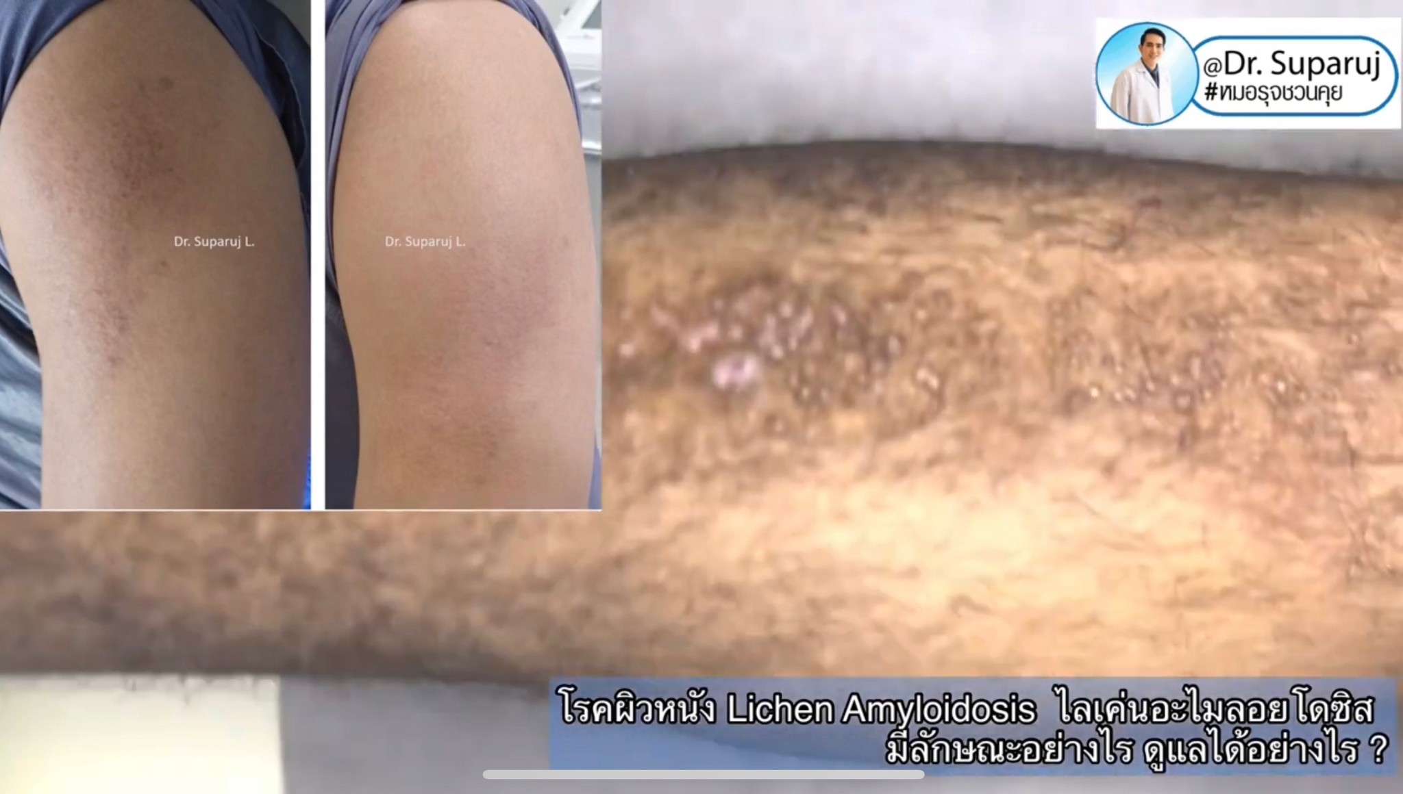 แนะนำการดูแลปัญหาโรคผิวหนัง: โรค Lichen amyloidosis ไลเค่น อะไมลอยโดซิส มีลักษณะอย่างไร ดูแลได้อย่างไร ? แนะนำการดูแลปัญหาโรคผิวหนัง: โรค Lichen amyloidosis ไลเค่น อะไมลอยโดซิส มีลักษณะอย่างไร ดูแลได้อย่างไร ?