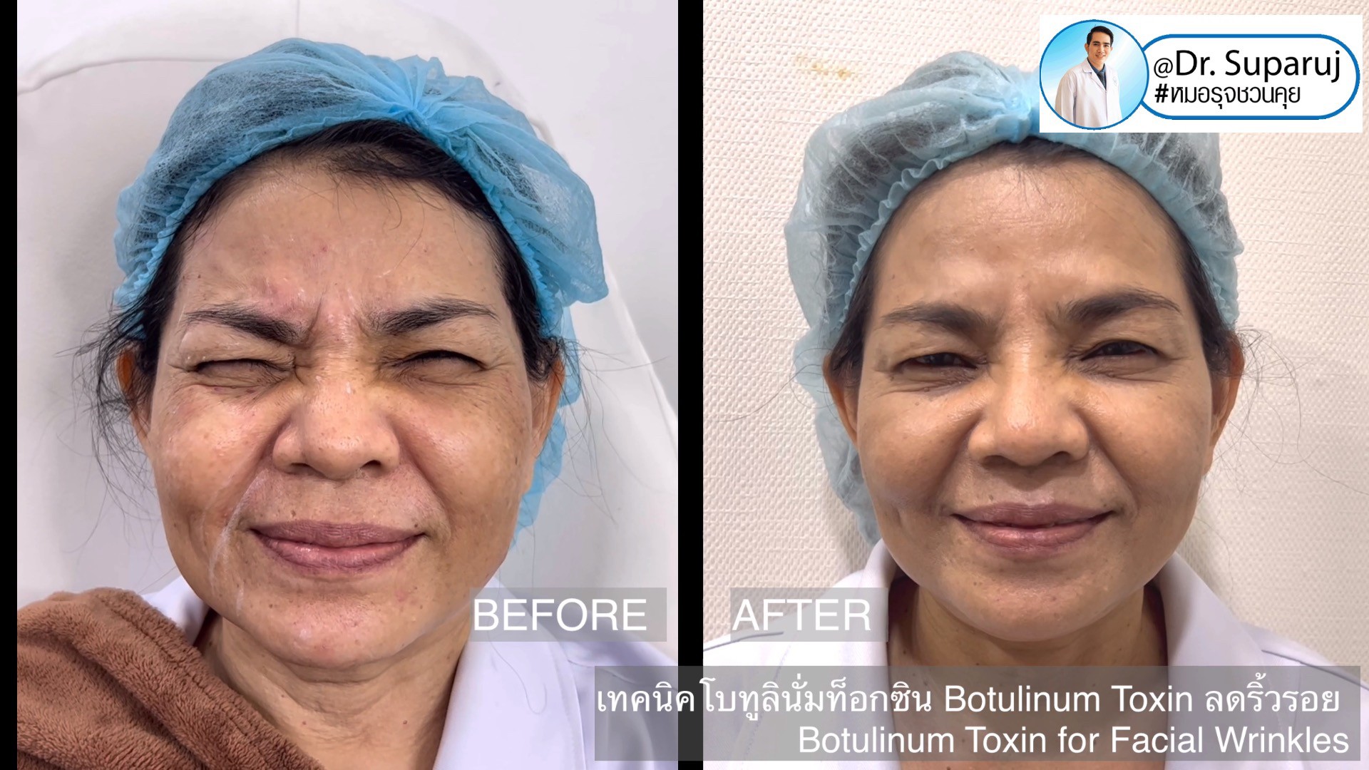 เทคนิคโบทูลินั่มท็อกซิน Botulinum Toxin ลดริ้วรอย Botulinum Toxin for Facial Wrinkles เทคนิคโบทูลินั่มท็อกซิน Botulinum Toxin ลดริ้วรอย Botulinum Toxin for Facial Wrinkles