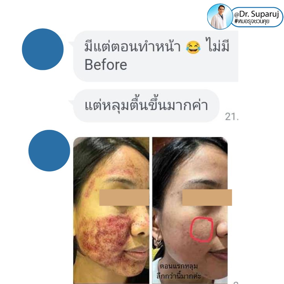 Update รักษาหลุมสิวด้วยเทคนิคการตัดพังผืด Blunt Blade Subcision (Blunt Blade Subcision for Acne Scar Fibrosis Treatment) Update รักษาหลุมสิวด้วยเทคนิคการตัดพังผืด Blunt Blade Subcision (Blunt Blade Subcision for Acne Scar Fibrosis Treatment)