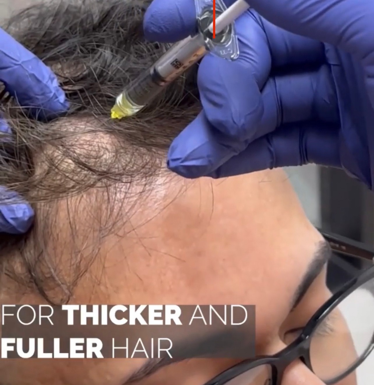 แนะนำเทคนิคดูแลปัญหาผมร่วงผมบาง: Exosome เอ็กโซโซม ช่วยดูแลผมร่วงผมบางได้อย่างไร? แนะนำเทคนิคดูแลปัญหาผมร่วงผมบาง: Exosome เอ็กโซโซม ช่วยดูแลผมร่วงผมบางได้อย่างไร?