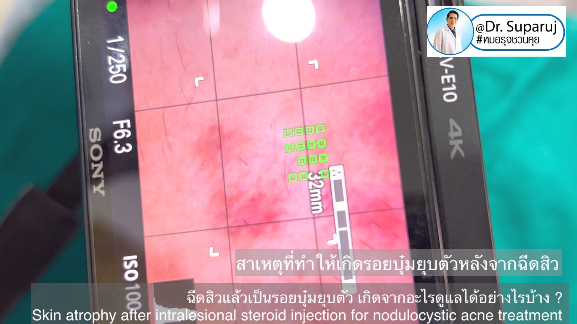 ฉีดสิวแล้วเป็นรอยบุ๋มยุบตัว เกิดจากอะไรดูแลได้อย่างไรบ้าง ?  (Skin atrophy after intralesional steroid injection for nodulocystic acne treatment )