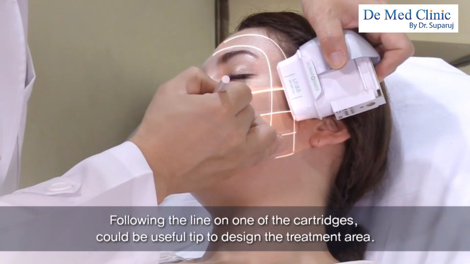 แนะนำเทคนิคดูแล ยกกระชับผิว: Ultraformer III นวัตกรรมคลื่นเสียงยกกระชับ ลดริ้วรอย กระชับผิว ดูแลหลุมสิวโดยไม่ต้องผ่าตัด แนะนำเทคนิคดูแล ยกกระชับผิว: Ultraformer III นวัตกรรมคลื่นเสียงยกกระชับ ลดริ้วรอย กระชับผิว ดูแลหลุมสิวโดยไม่ต้องผ่าตัด