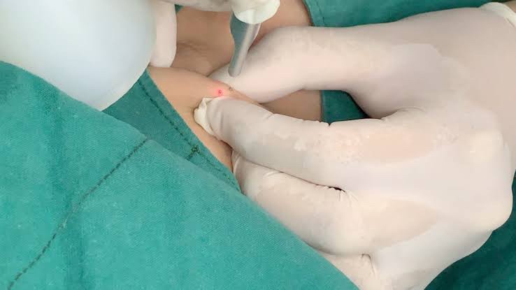 แนะนำเทคนิคดูแล ก้อนซีสต์จากท่อต่อมไขมัน Steatocystoma Multiplex (SM) ด้วย เข็มพลังงานคลื่นวิทยุ Insulated Radiofrequency RF Microneedle for Steatocystoma Multiplex Treatment แนะนำเทคนิคดูแล ก้อนซีสต์จากท่อต่อมไขมัน Steatocystoma Multiplex (SM) ด้วย เข็มพลังงานคลื่นวิทยุ Insulated Radiofrequency RF Microneedle for Steatocystoma Multiplex Treatment